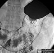 Hyperplastic Gastric Polyps